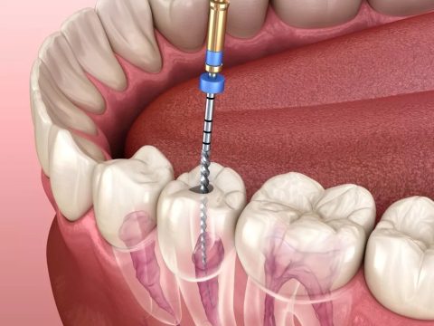 Choosing a Dentist for Teeth Whitening Purposes
