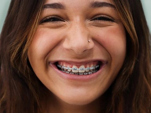 Veneers Or Crowns - Which Option Is Best For You?