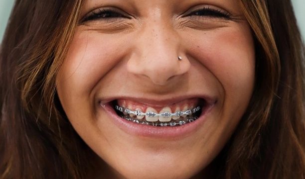 Veneers Or Crowns - Which Option Is Best For You?